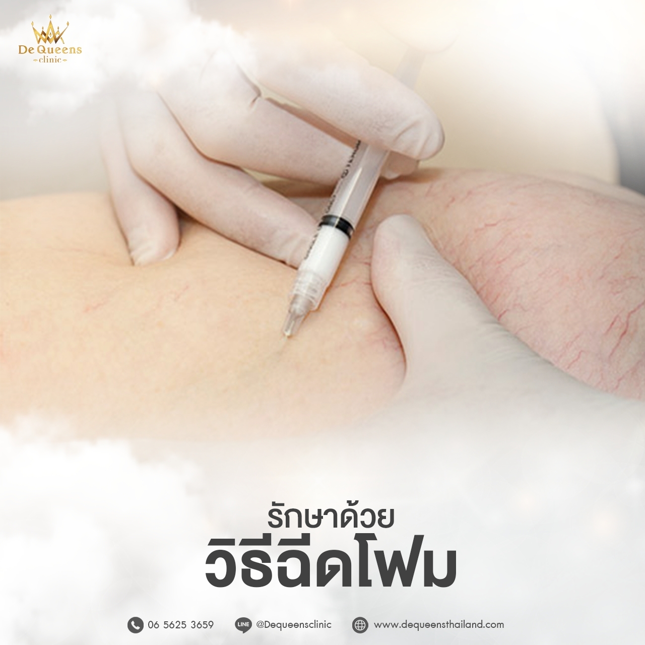 3 นาที บอกลาเส้นเลือดขอด ได้ด้วยการฉีดสลายเส้นเลือดขอด เทคนิค Advance Queens Foam Sclerotherapy