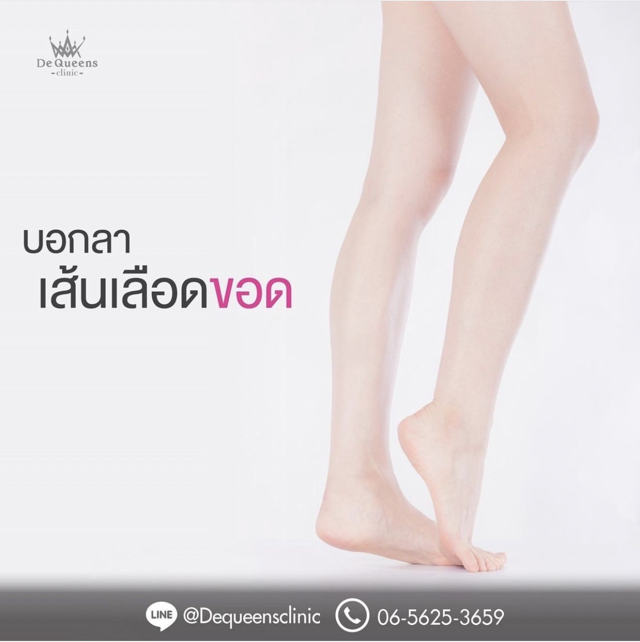 เส้นเลือดขอดที่ขา เกิดจาก ? เช็คระยะ เส้นเลือดขอด ระดับไหนปล่อยไว้ไม่ได้แล้ว