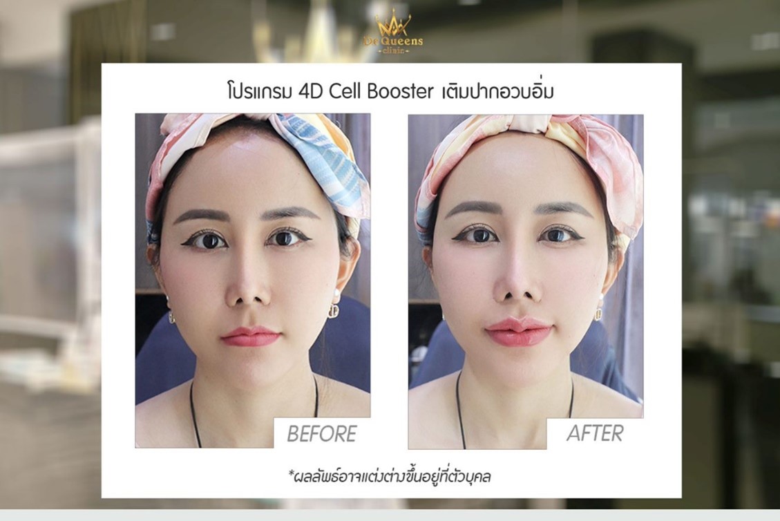 ฉีดฟิลเลอร์ปาก
