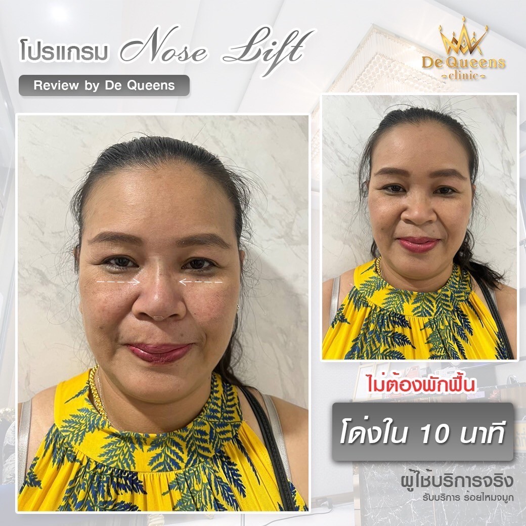 รู้ไว้ก่อนฉีด เทรนด์ใหม่มาแรง ฟิลเลอร์ปากอวบอิ่ม สไตล์สายฝอ