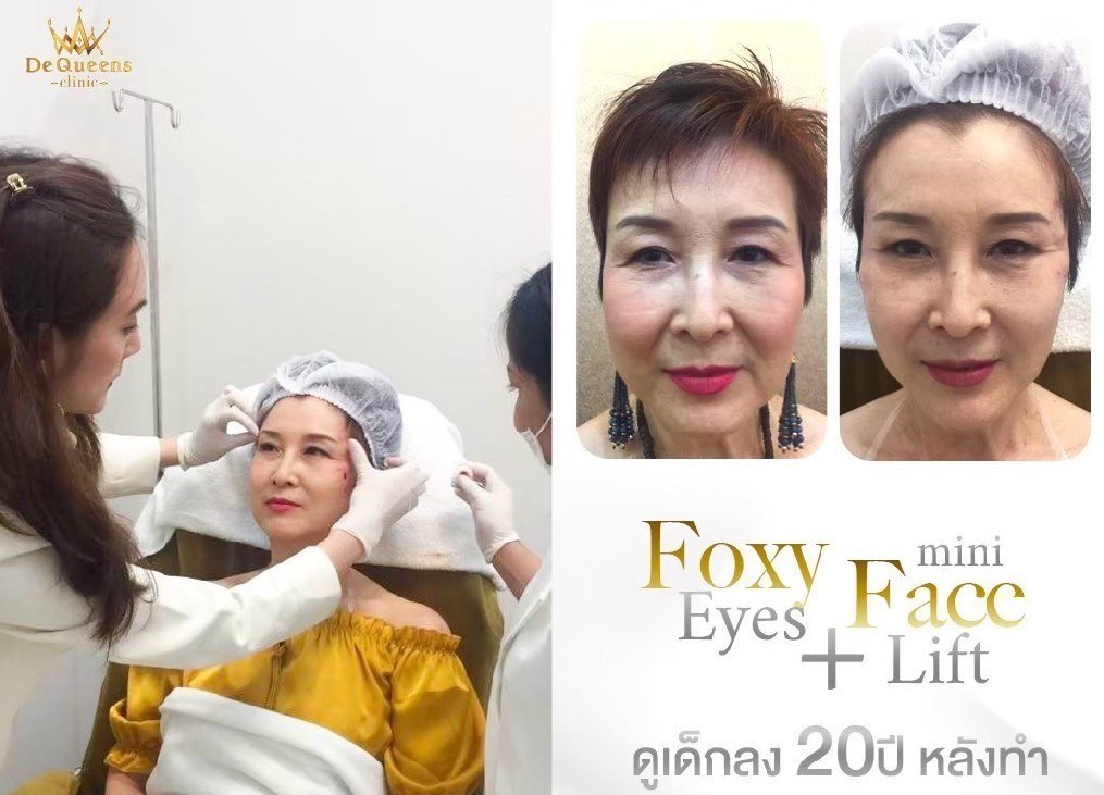 ร้อยไหม Foxy Eyes