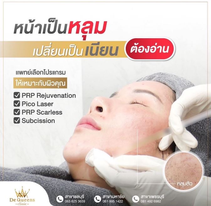 หน้าเป็นหลุมสิว อยากเปลี่ยนเป็นเนียน ต้องอ่าน !!