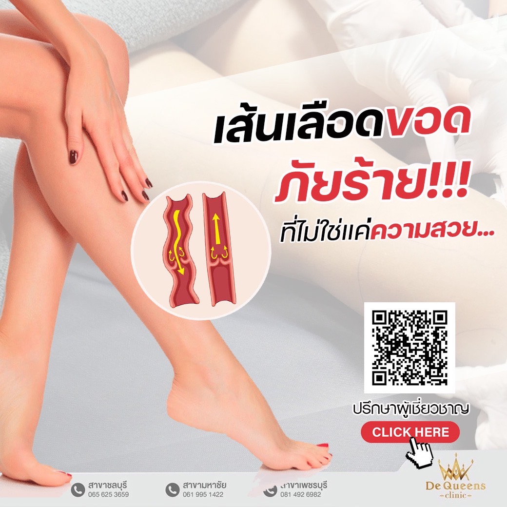 รู้เท่าทันอาการเส้นเลือดขอด