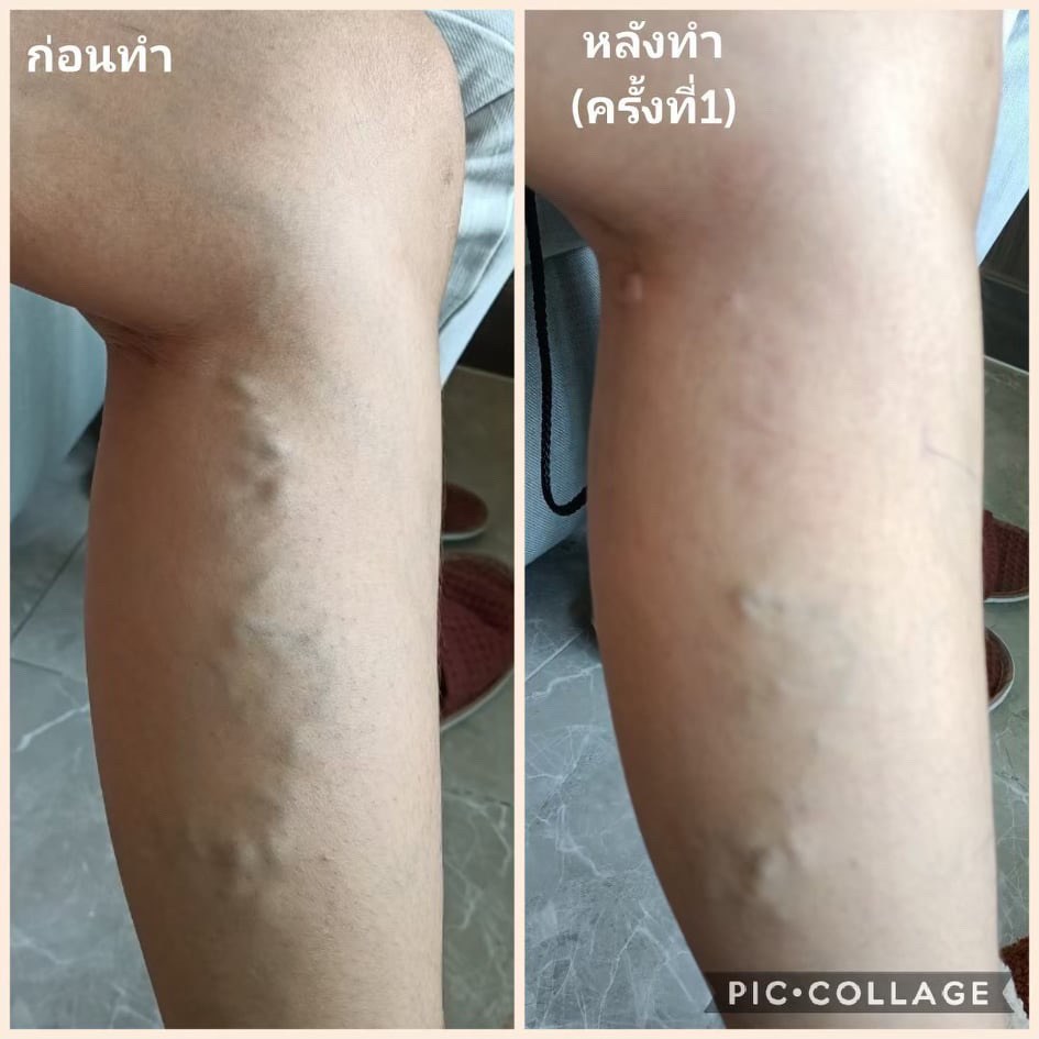 เส้นเลือดขอดที่ขา ปัญหากวนใจสาวๆ อย่าชะล่าใจ เพราะอันตรายกว่าที่คิด