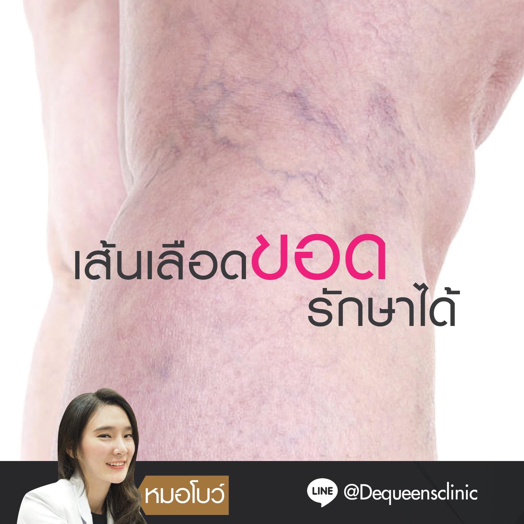 เส้นเลือดขอด