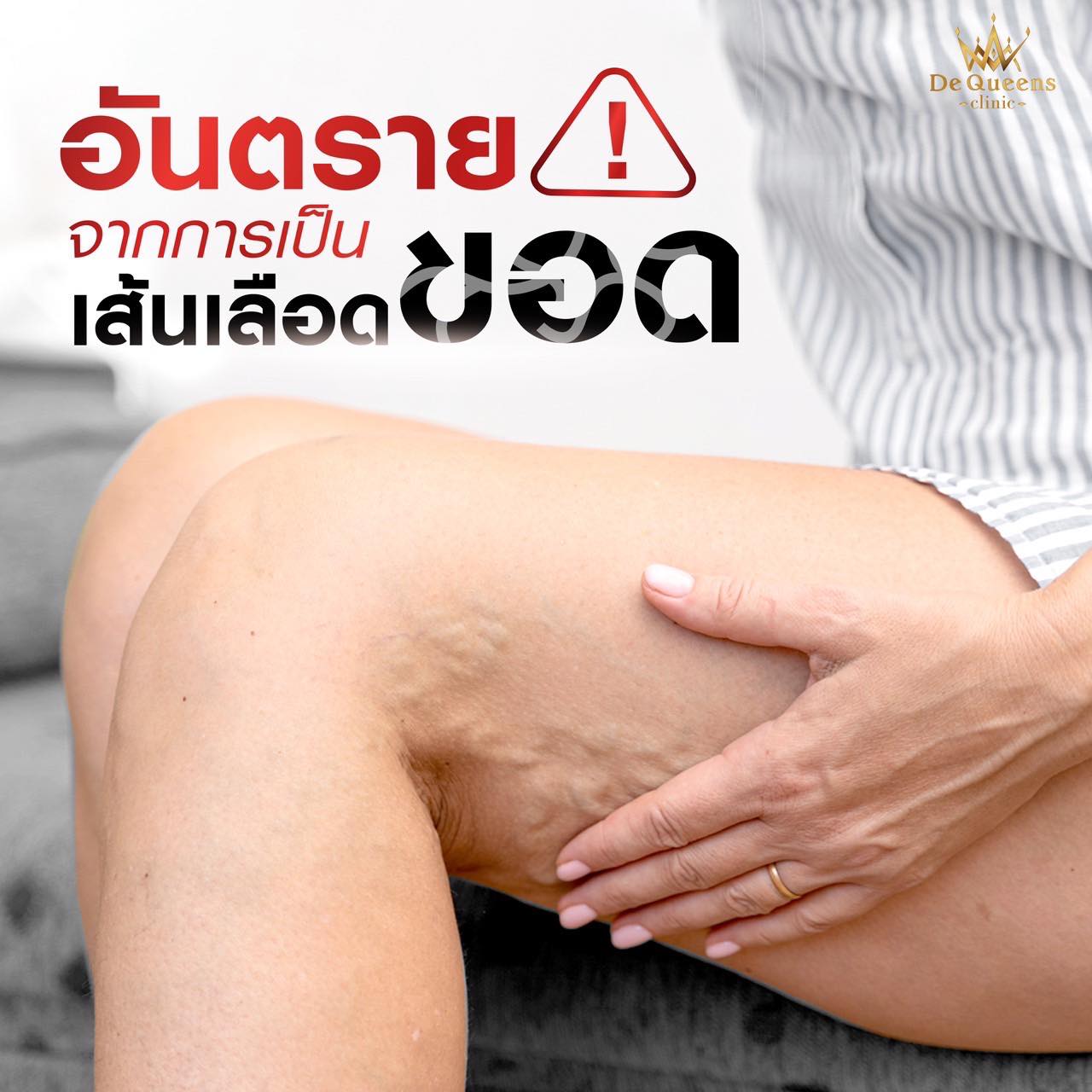 อันตรายจากการเป็นเส้นเลือดขอด