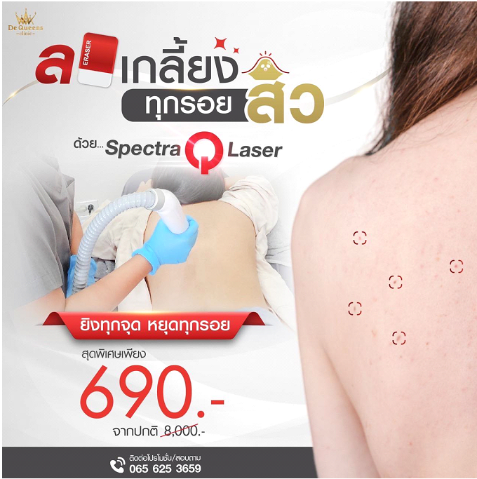 บอกลาหลังด่าง เพราะรอยสิว ด้วยเลเซอร์ Spectra Q Laser