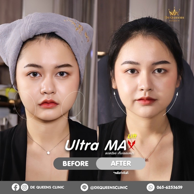รีวิว Ultra Max Lift บอกลาหน้าบาน แก้มย้อย เหนียงเยอะ!!