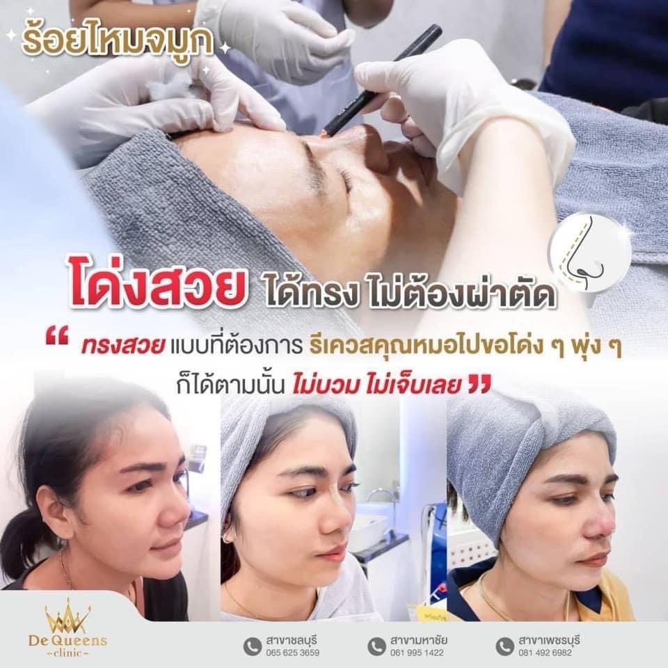 Nose Lift คืออะไร
