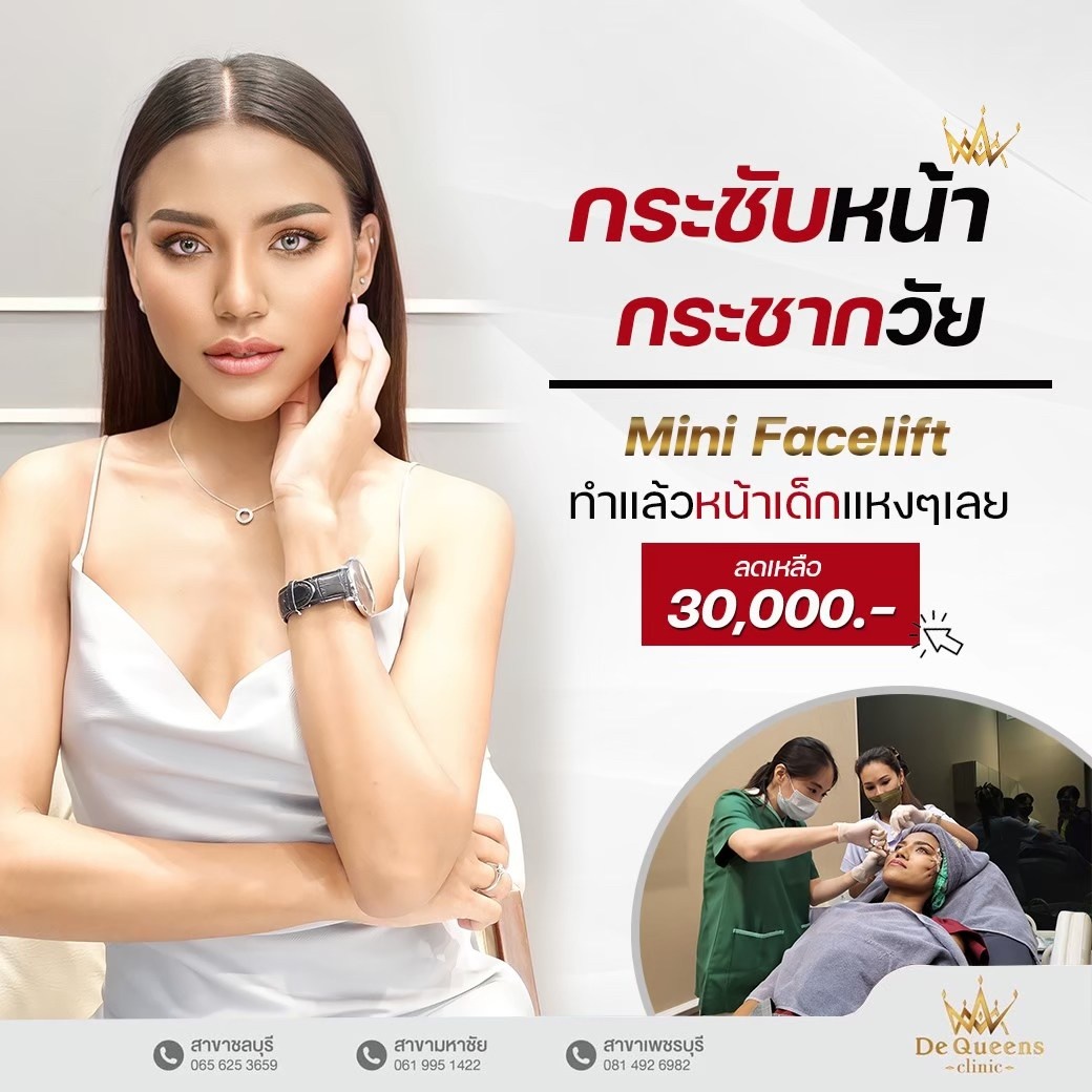 ร้อยไหม Mini Face Lift