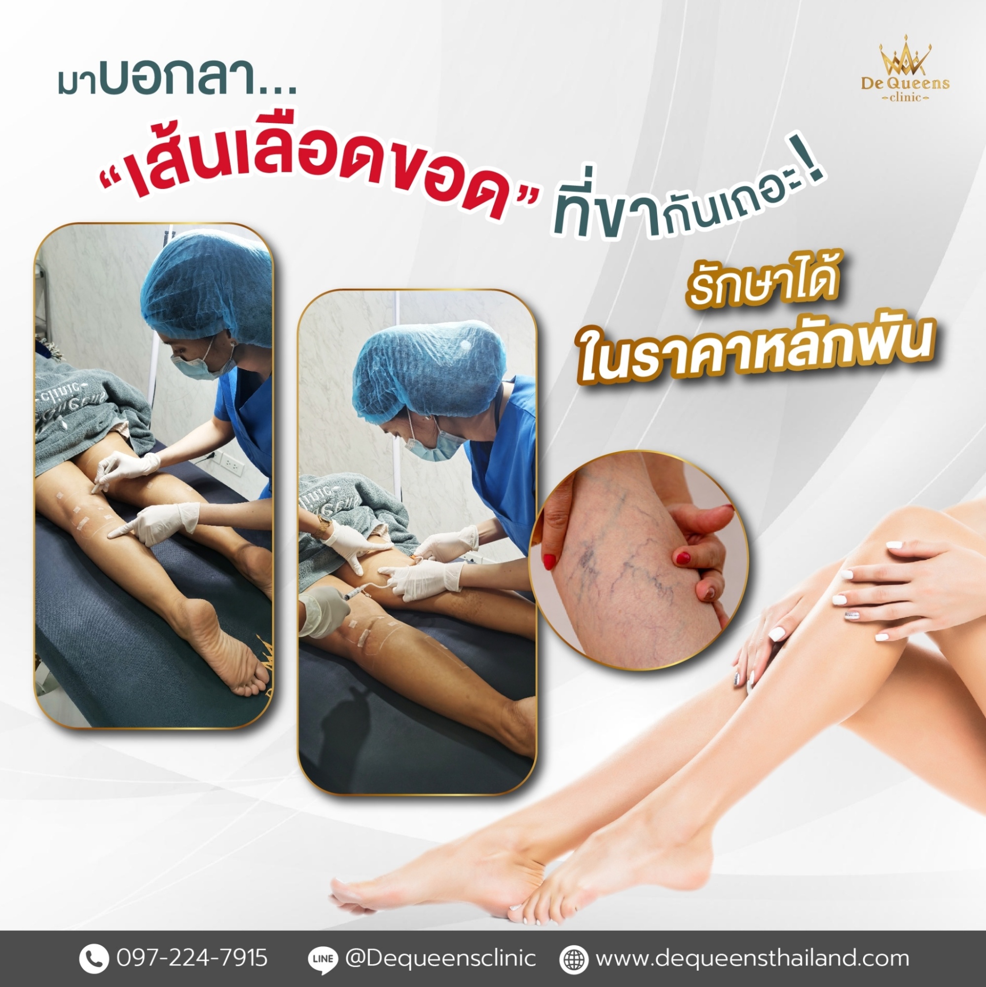 เส้นเลือดขอดคืออะไร? ไขข้อสงสัยพร้อมวิธีรักษา