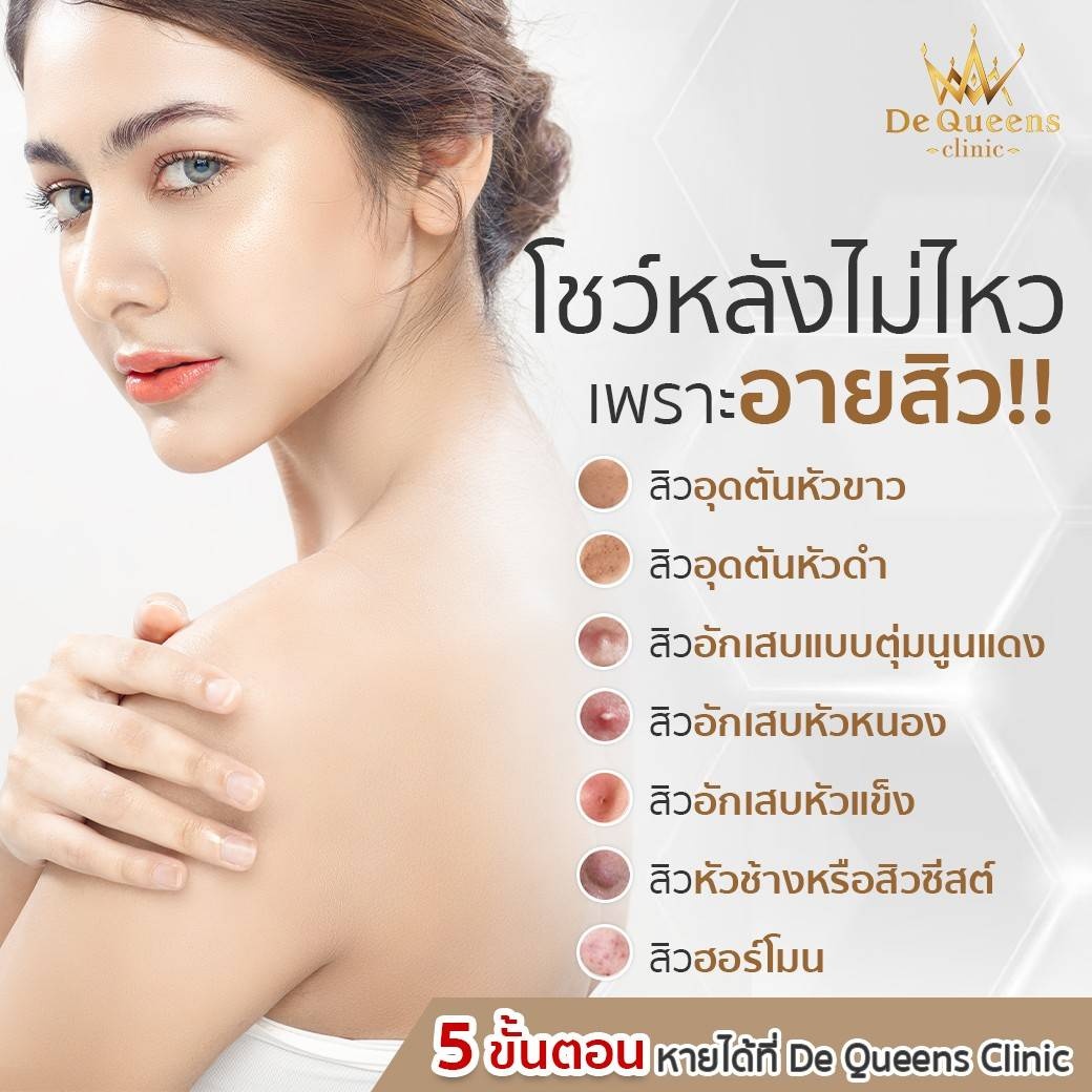 กำจัดรอยสิว ลดเลือนรอยดำที่หลัง ด้วยเลเซอร์ Q-Switch