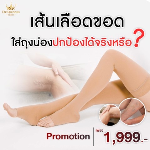 เส้นเลือดขอด ใส่ถุงน่องแล้วปกป้องได้จริงหรือ?