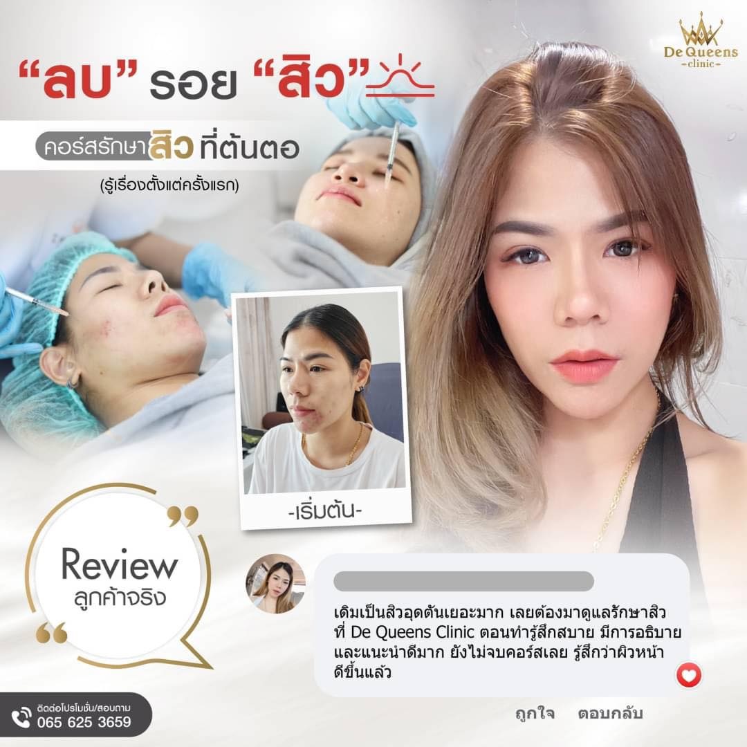 รีวิว รักษาสิวที่ De Queens จบปัญหาสิวซ้ำซาก ด้วยโปรแกรมรักษาสิว 4 ขั้นตอน