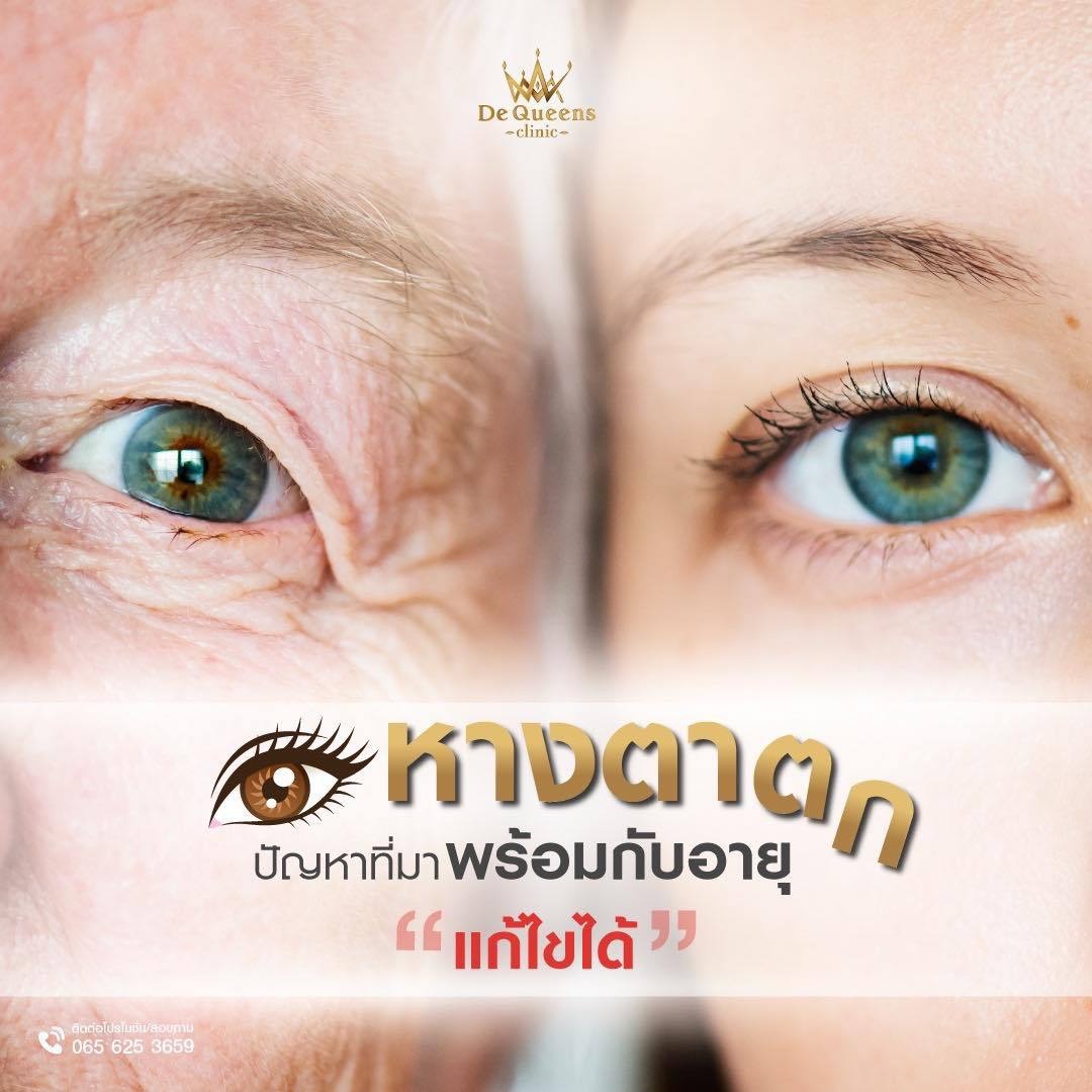 หางตาตก ปัญหาที่มาพร้อมกับอายุ แก้ได้ด้วย Foxy Eyes