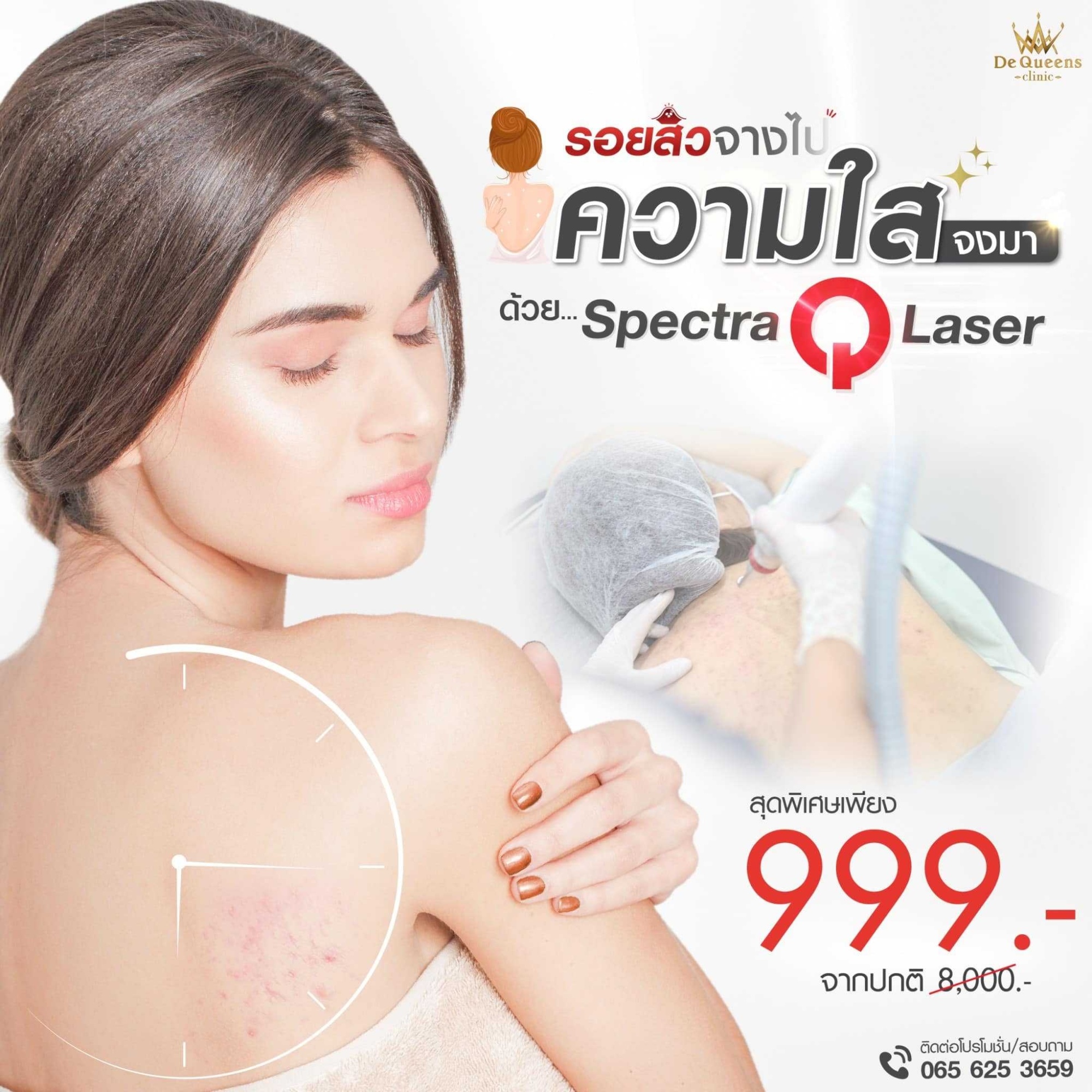 Spectra Q Laser