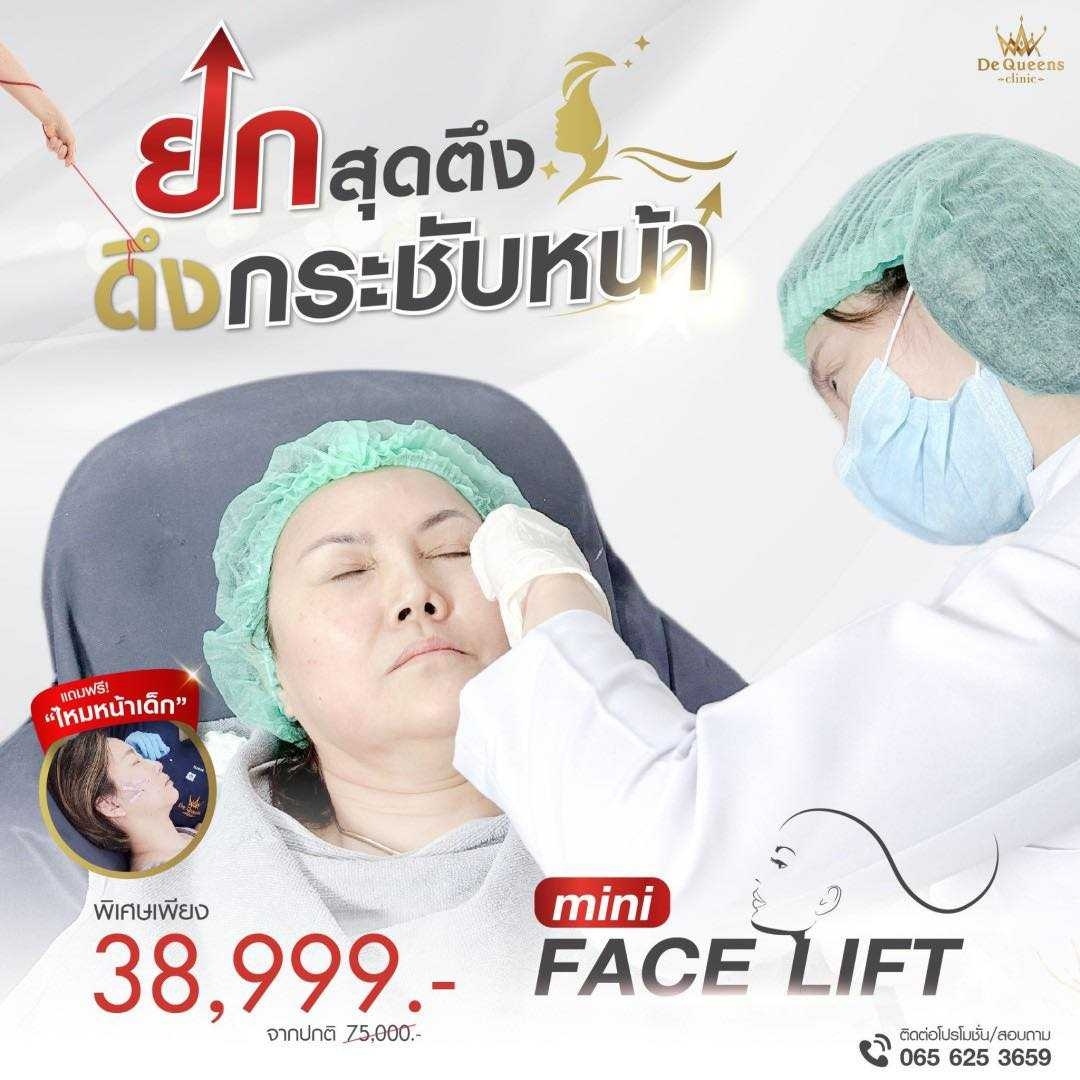 โปรโมชั่นร้อยไหมหน้าเด็ก Mini Face Lift