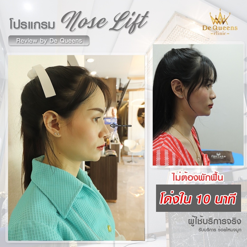 รีวิว ร้อยไหมจมูก