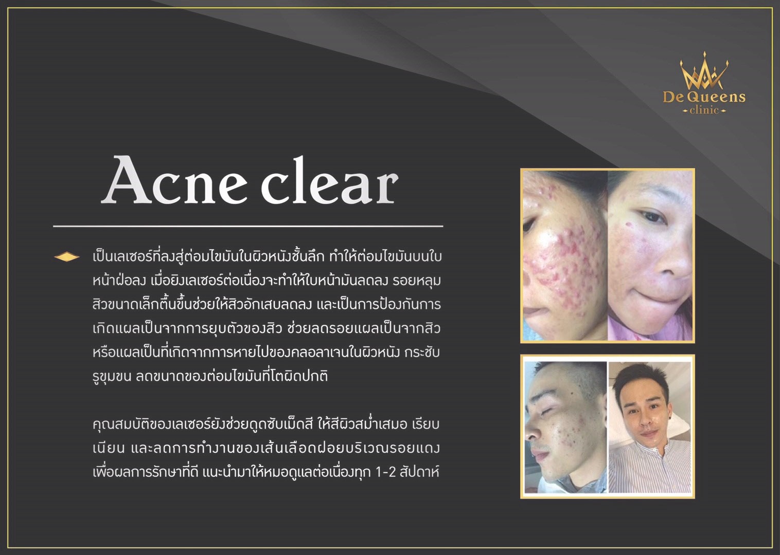 Acne Clear