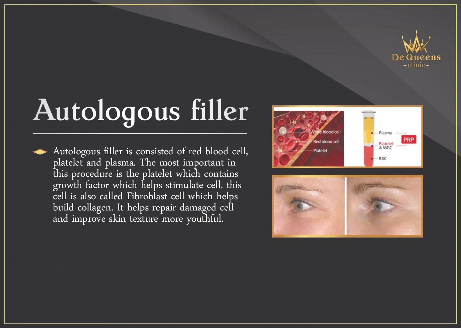 Autologous filler