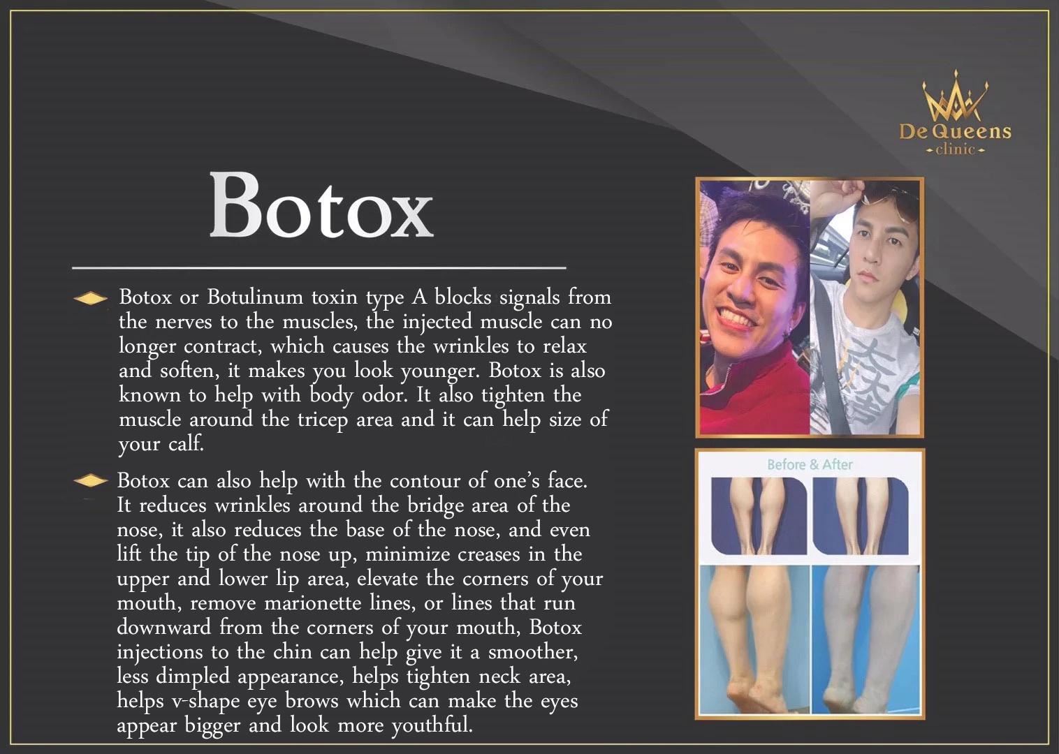Botox