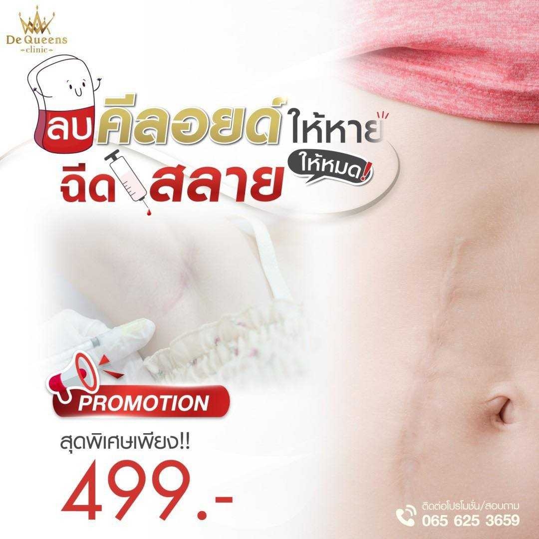 คีลอยด์  พิเศษเพียง 499 บาท