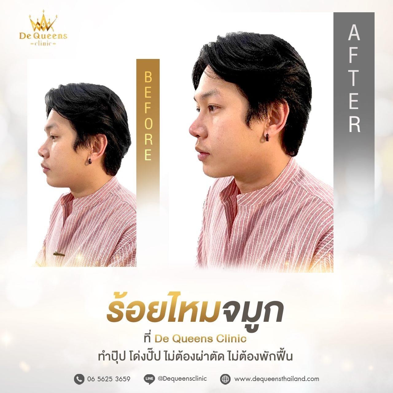 ไหมจมูก ชลบุรี,ร้อยไหมจมูก ชลบุรี,เสริมจมูก ชลบุรี