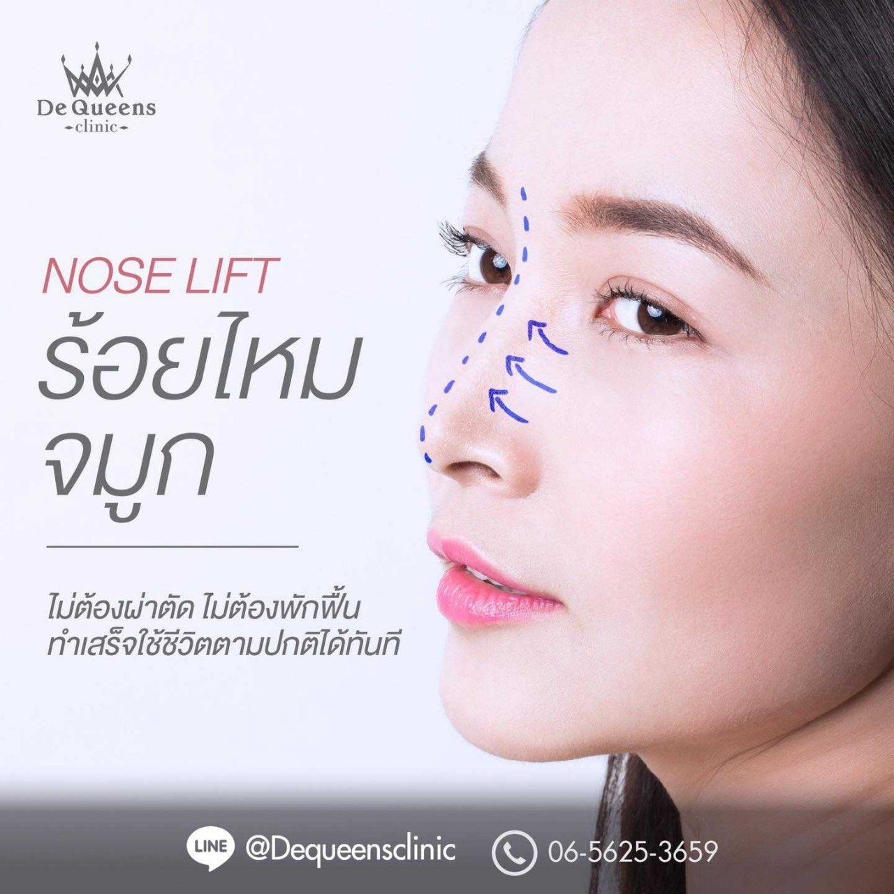 ร้อยไหมจมูก,ร้อยไหมจมูก ชลบุรี, ร้อยไหมจมูก เพชรบุรี