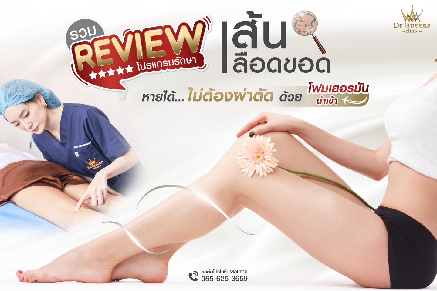 รีวิวเส้นเลือดขอด