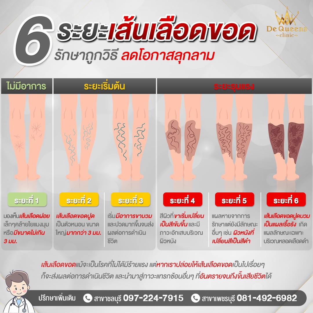 เช็ก 6 ระยะ เส้นเลือดขอดที่ส่งผลกระทบต่อการดำเนินชีวิต