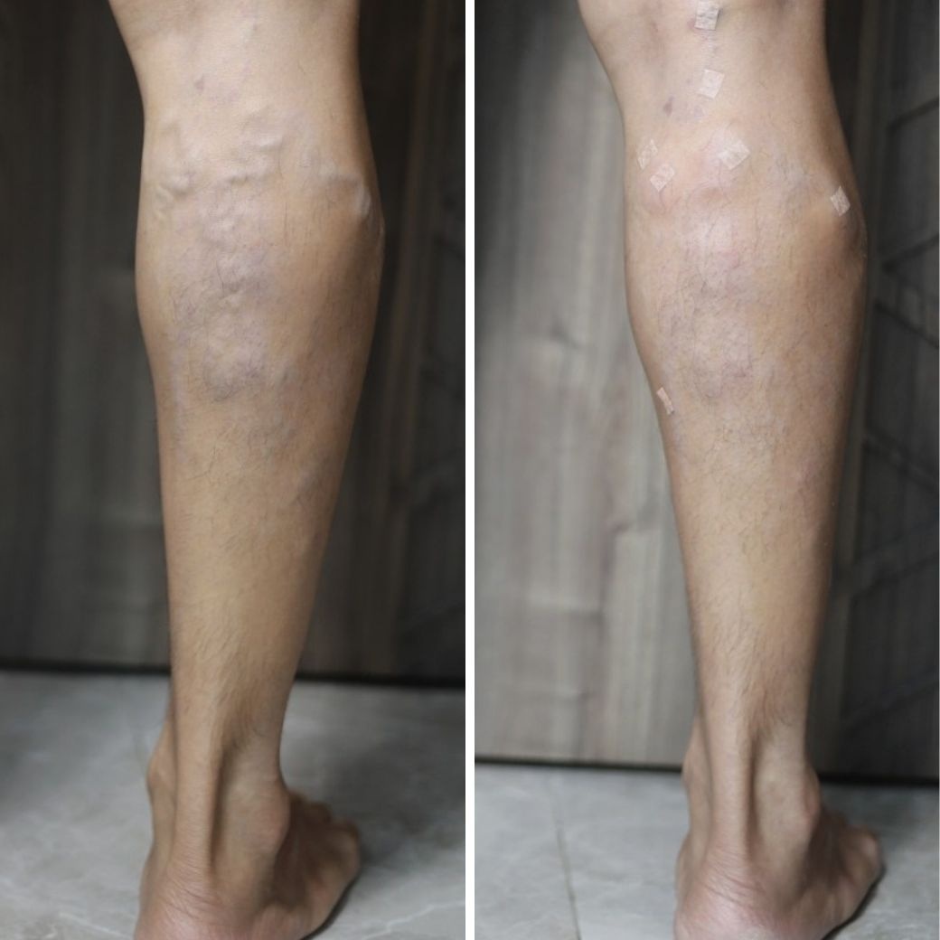 ภาพรีวิวลูกค้ารักษาเส้นเลือดขอด ผู้ชาย และผู้หญิง Before After