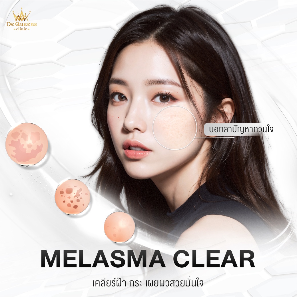 รักษาฝ้าชลบุรี เพชรบุรี Melasma Clear