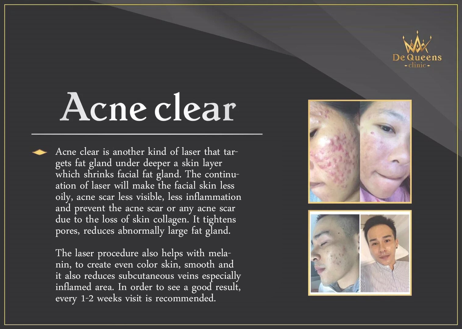 Acne clear