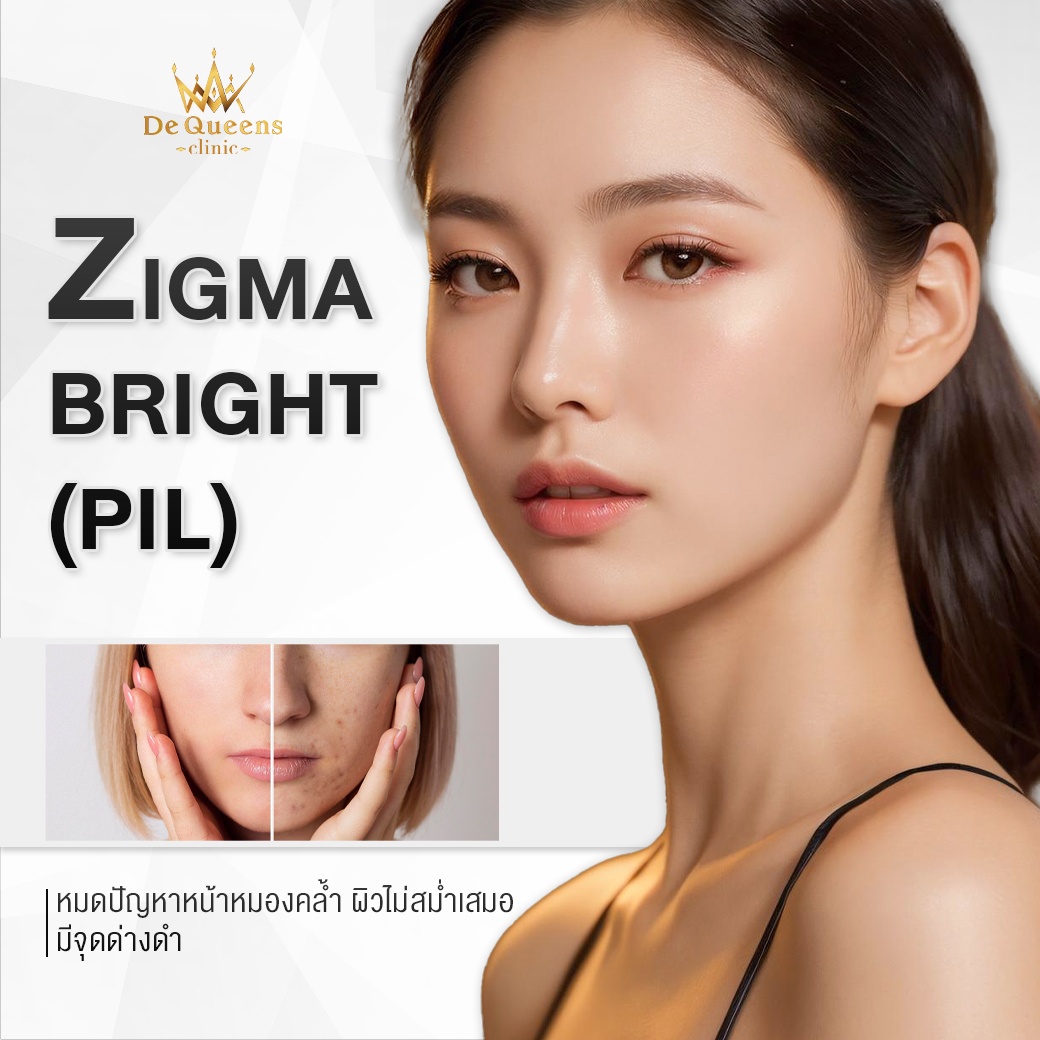 ฟื้นฟูหน้าใสด้วย Zigma bright (IPL)