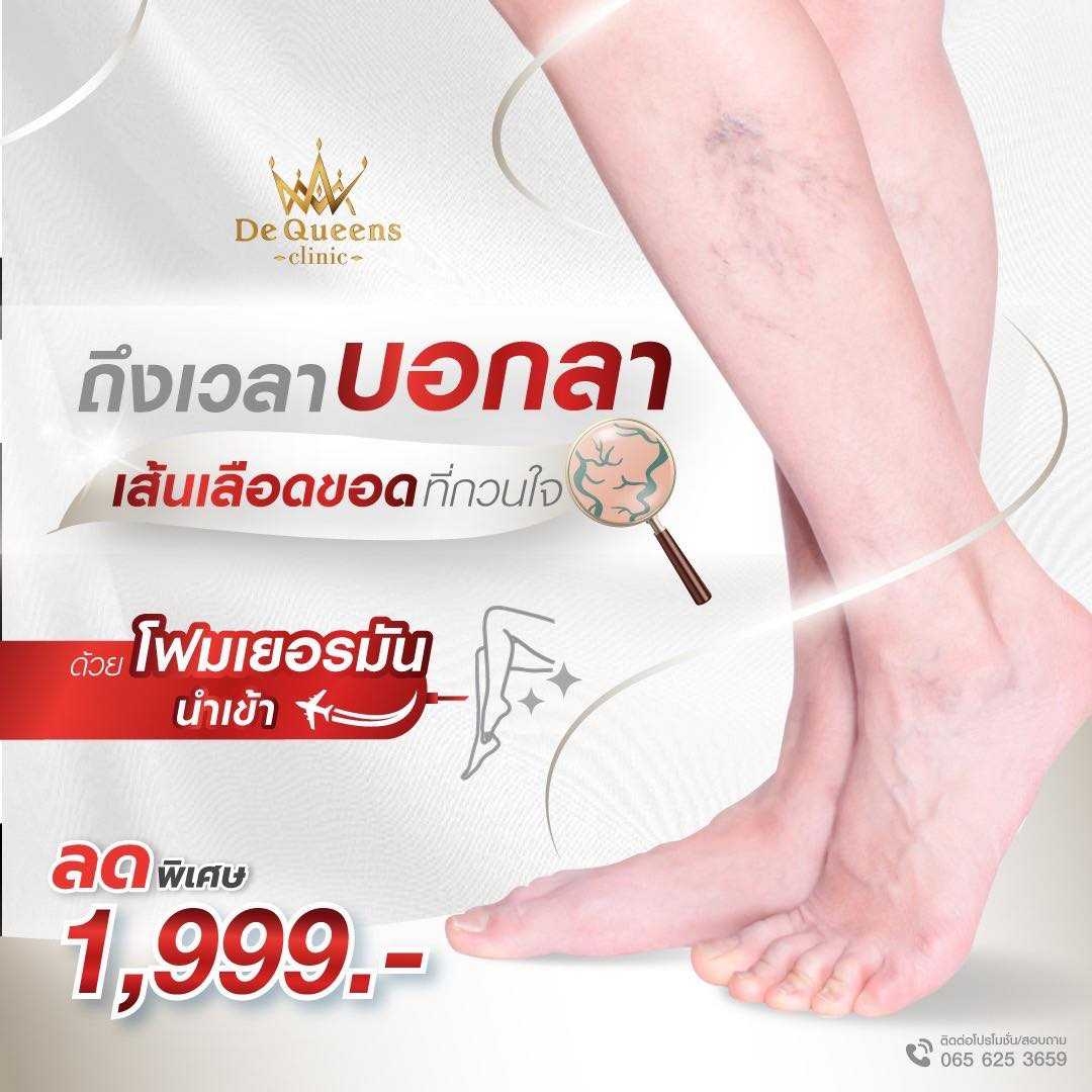 รักษาเส้นเลือดขอด ชลบุรี เพชรบุรี  1,999 บาท จำนวนจำกัด