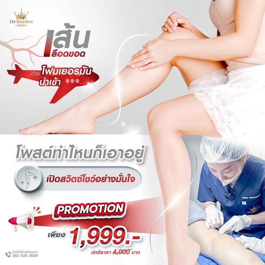 รักษาเส้นเลือดขอด