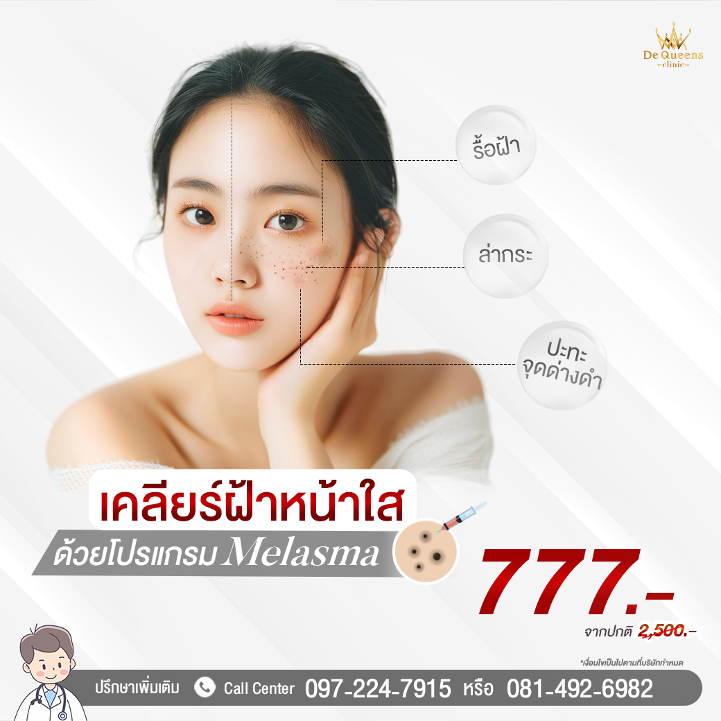 Melasma รักษาฝ้า 777
