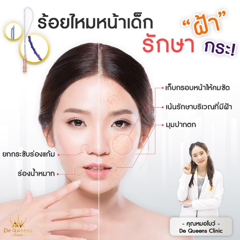 5 ข้อควรรู้ก่อนฉีด PRP