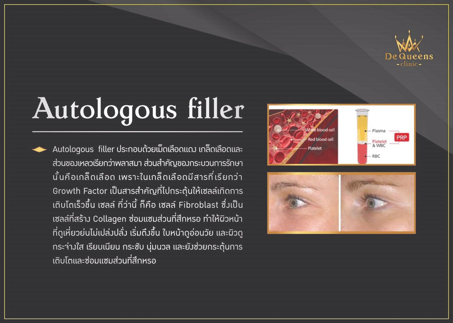 Autologous filler