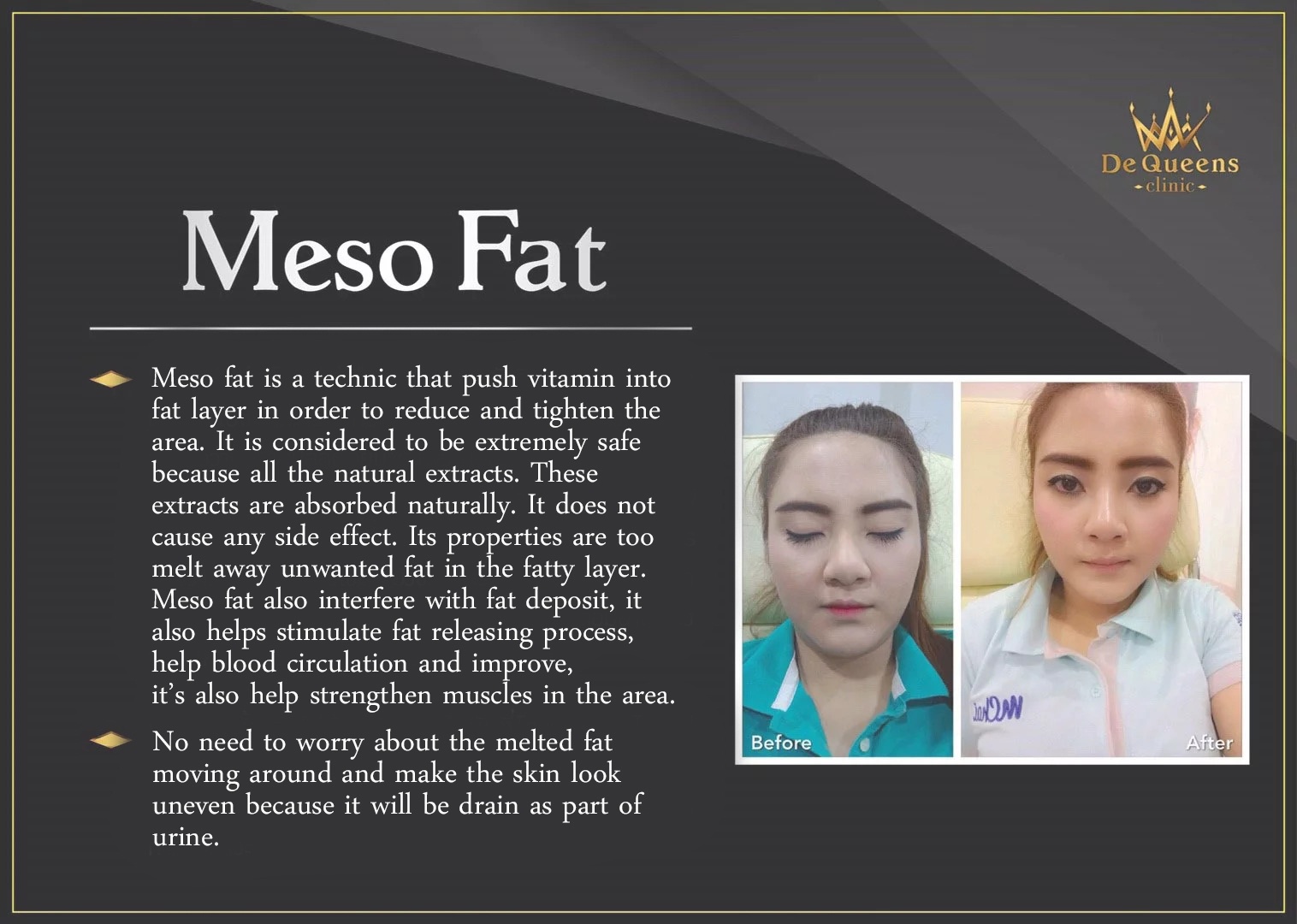 Meso Fat